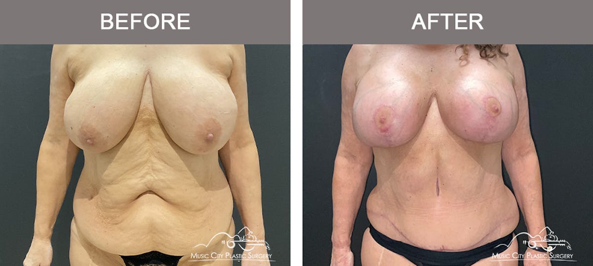 Abdominoplasty Before & After Gallery - Patient 208221 - Image 1