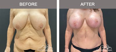 Abdominoplasty Before & After Gallery - Patient 208221 - Image 1