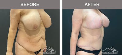 Abdominoplasty Before & After Gallery - Patient 208221 - Image 2