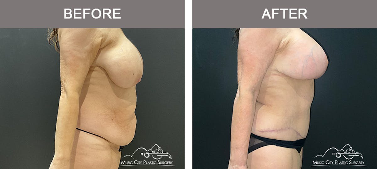 Abdominoplasty Before & After Gallery - Patient 208221 - Image 3