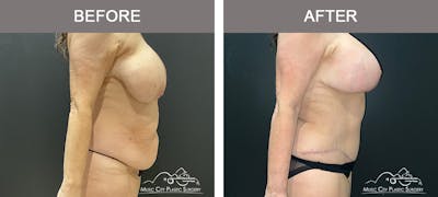 Abdominoplasty Before & After Gallery - Patient 208221 - Image 3