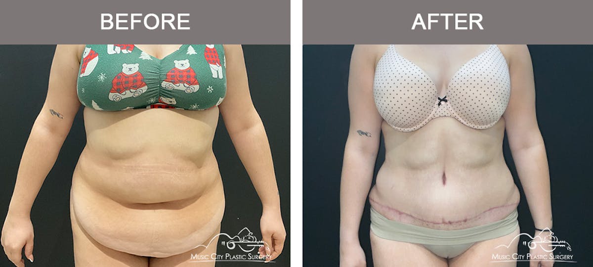 Abdominoplasty Before & After Gallery - Patient 457291 - Image 1