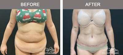 Abdominoplasty Before & After Gallery - Patient 457291 - Image 1
