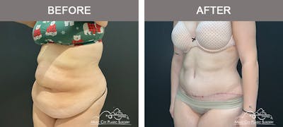 Abdominoplasty Before & After Gallery - Patient 457291 - Image 2
