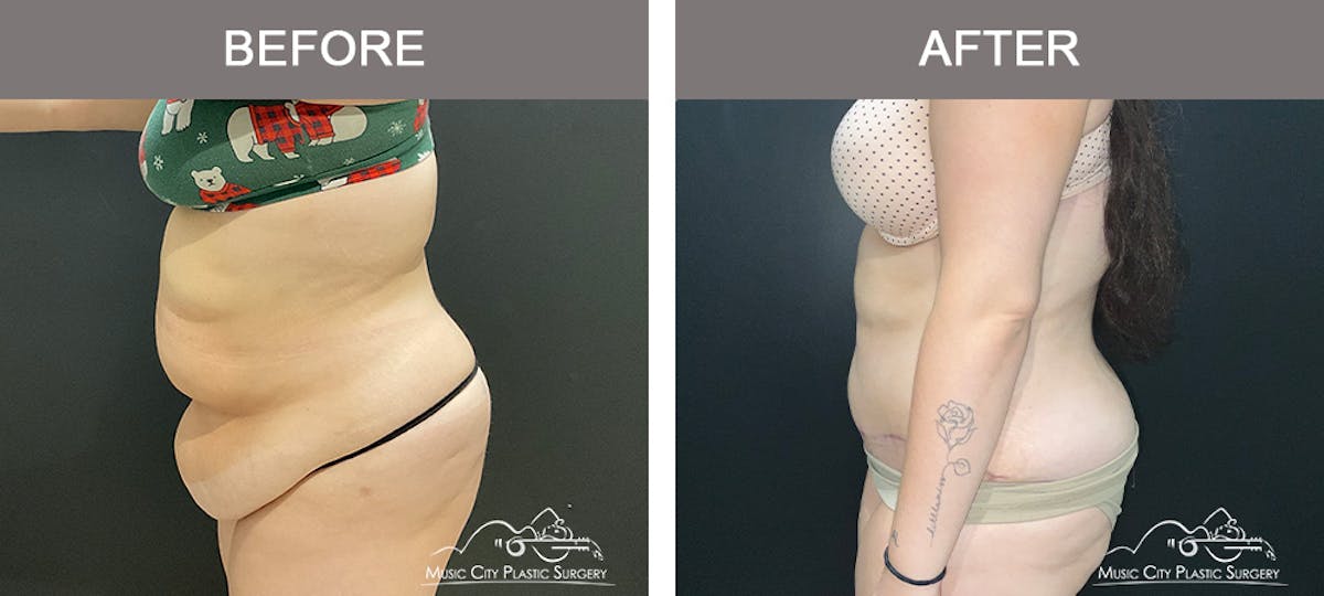 Abdominoplasty Before & After Gallery - Patient 457291 - Image 3
