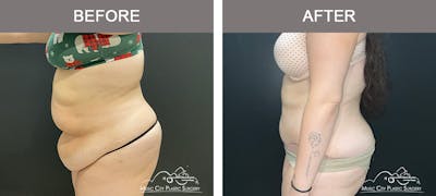 Abdominoplasty Before & After Gallery - Patient 457291 - Image 3