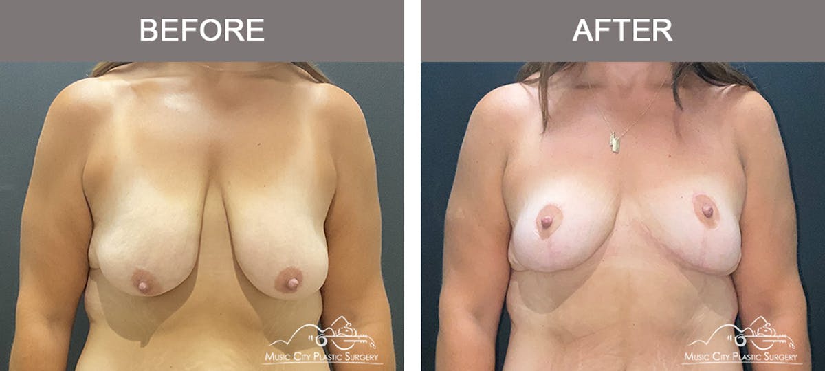 Breast Lift Before & After Gallery - Patient 409020 - Image 1