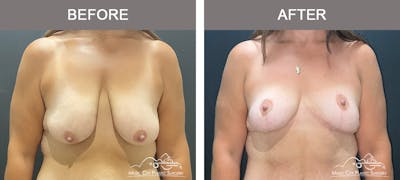 Breast Lift Before & After Gallery - Patient 409020 - Image 1