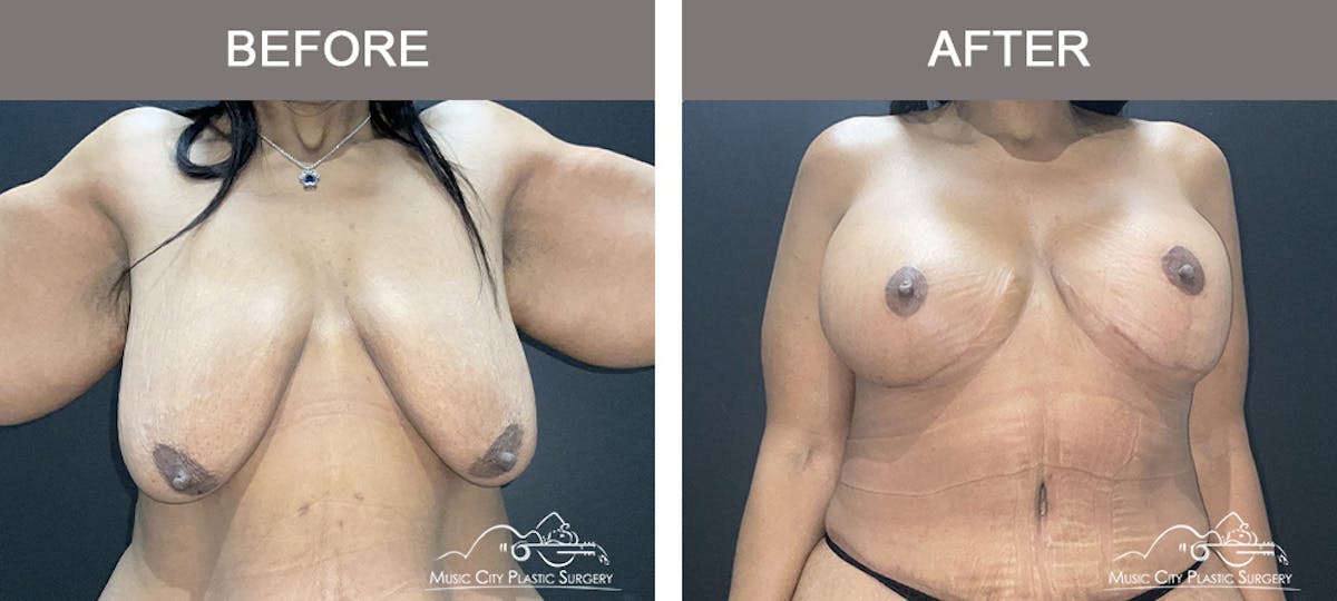 Breast Lift Before & After Gallery - Patient 342180 - Image 1