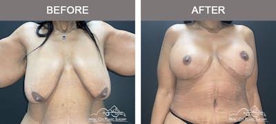 Breast Lift Before & After Gallery - Patient 342180 - Image 1