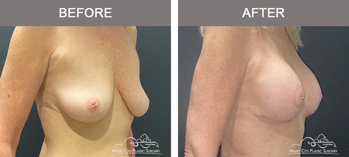 Breast Lift Before & After Gallery - Patient 166720 - Image 2