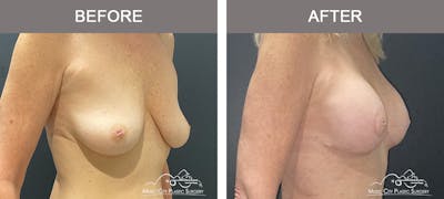 Breast Lift Before & After Gallery - Patient 166720 - Image 2