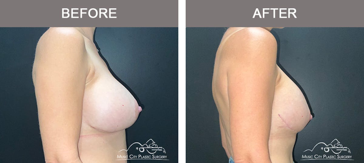 Breast Lift Before & After Gallery - Patient 322849 - Image 3