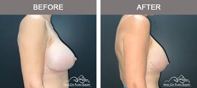 Breast Lift Before & After Gallery - Patient 322849 - Image 3