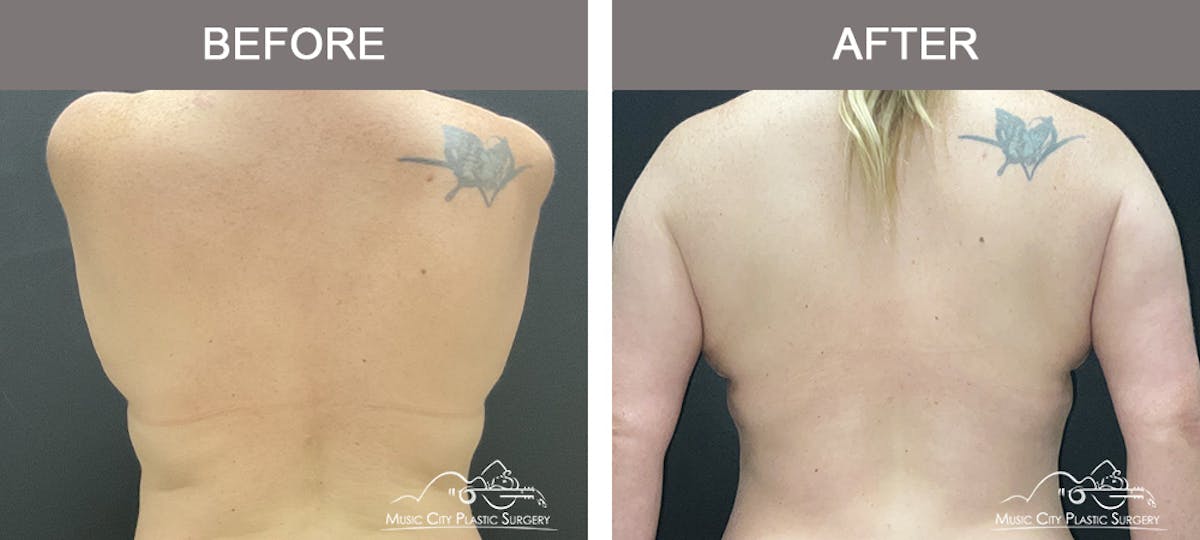 Breast Lift Before & After Gallery - Patient 383368 - Image 3