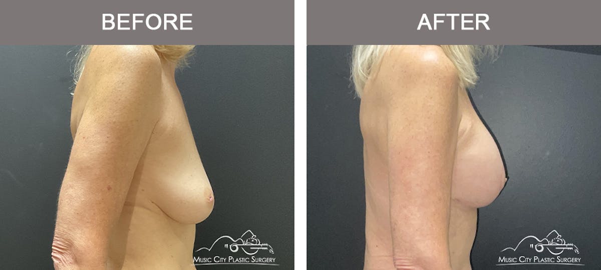 Breast Lift Before & After Gallery - Patient 166720 - Image 3