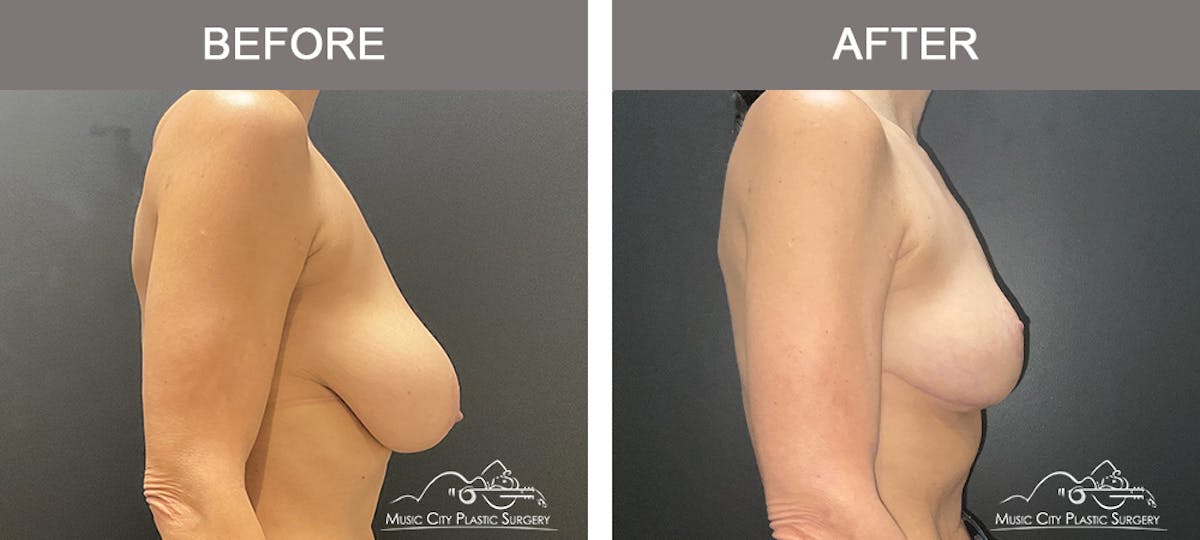 Breast Lift Before & After Gallery - Patient 167552 - Image 3