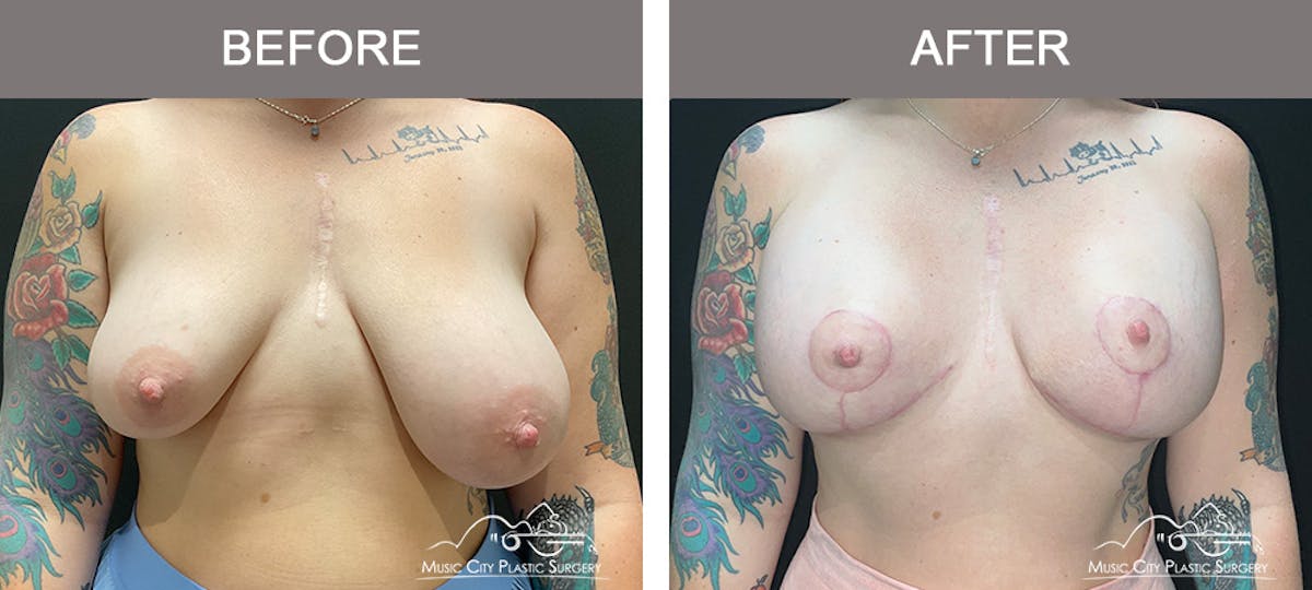 Breast Lift Before & After Gallery - Patient 362510 - Image 1
