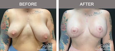 Breast Lift Before & After Gallery - Patient 362510 - Image 1