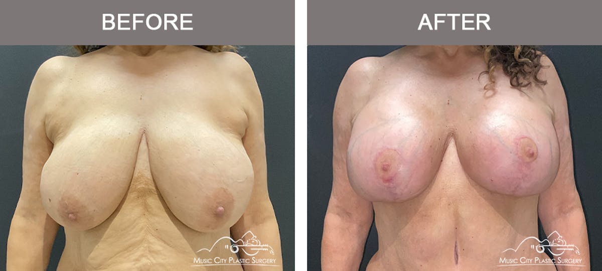 Breast Lift Before & After Gallery - Patient 154251 - Image 1