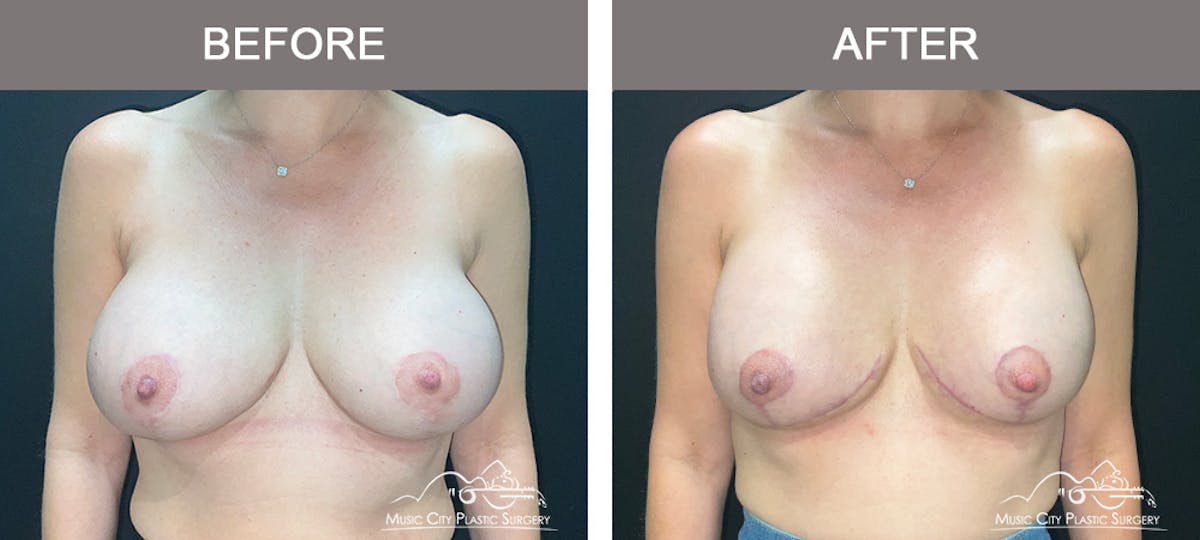 Breast Lift Before & After Gallery - Patient 322849 - Image 1