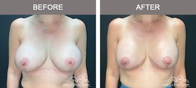 Breast Lift Before & After Gallery - Patient 322849 - Image 1