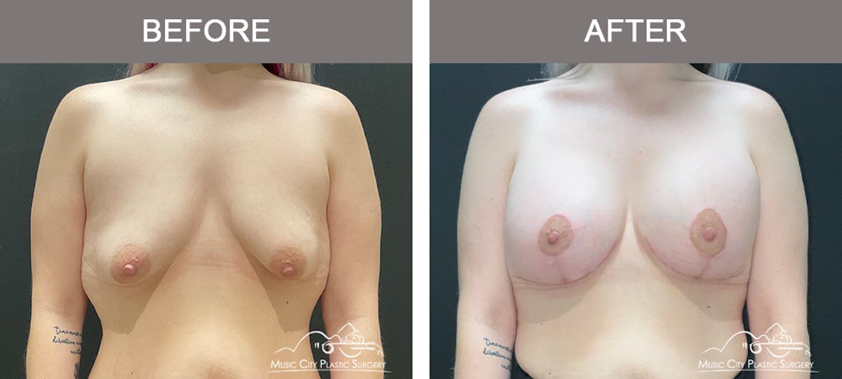 Breast Lift Before & After Gallery - Patient 148651 - Image 1