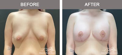 Breast Lift Before & After Gallery - Patient 148651 - Image 1