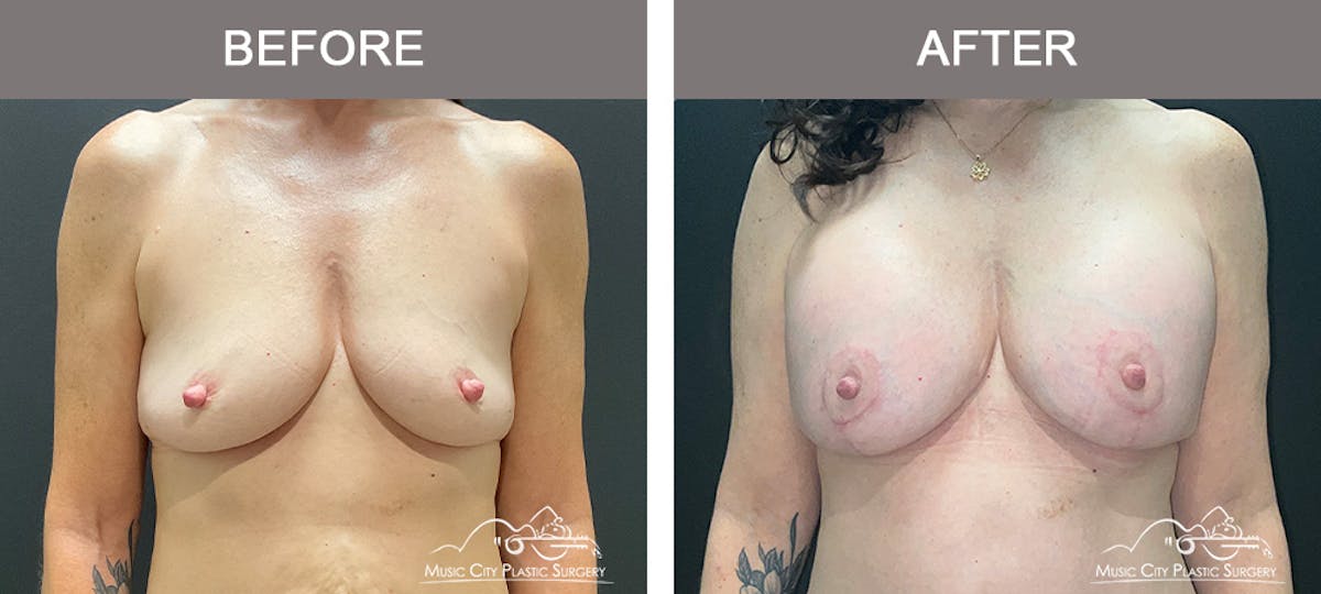 Breast Lift Before & After Gallery - Patient 190716 - Image 1