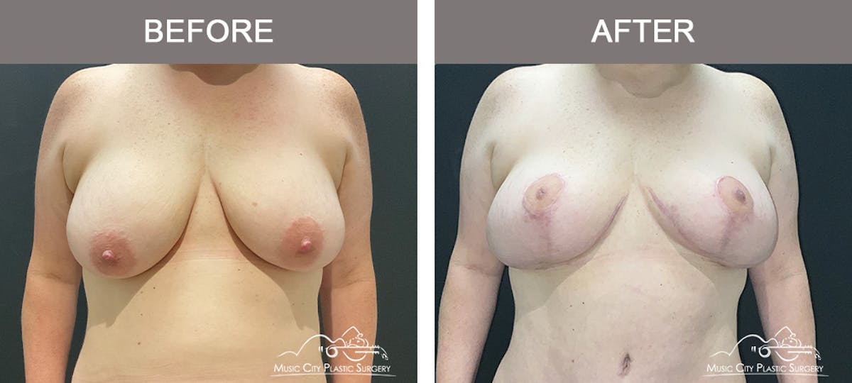 Breast Lift Before & After Gallery - Patient 383368 - Image 1