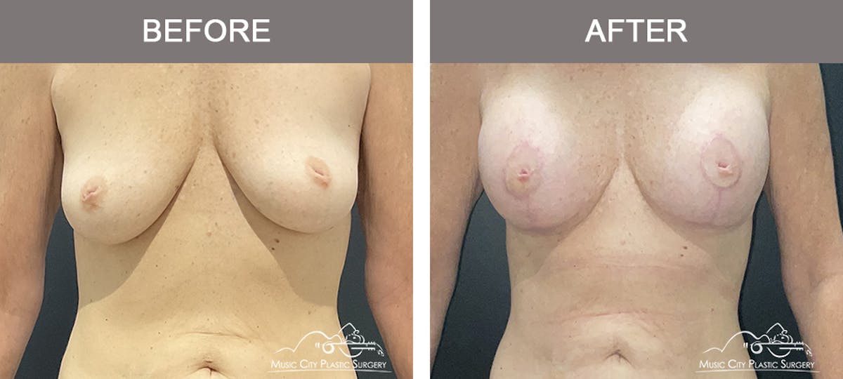 Breast Lift Before & After Gallery - Patient 166720 - Image 1