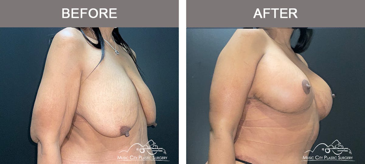Breast Lift Before & After Gallery - Patient 342180 - Image 2