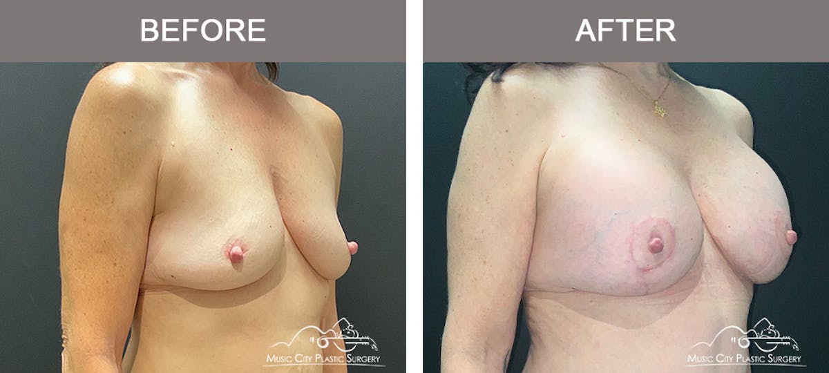 Breast Lift Before & After Gallery - Patient 190716 - Image 2