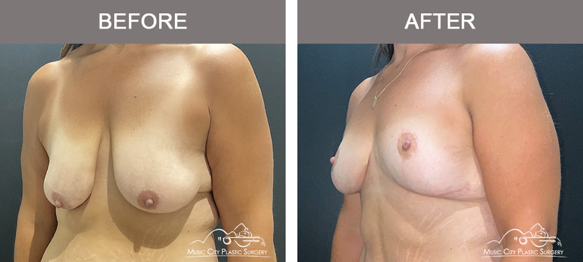 Breast Lift Before & After Gallery - Patient 409020 - Image 2