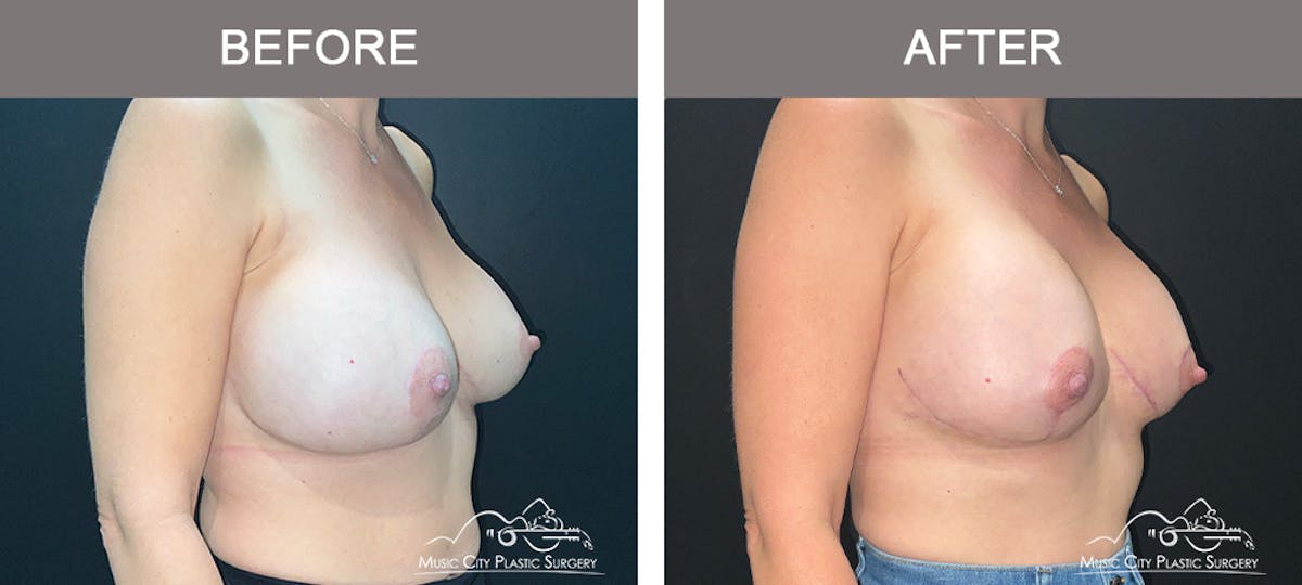 Breast Lift Before & After Gallery - Patient 322849 - Image 2