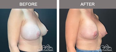 Breast Lift Before & After Gallery - Patient 322849 - Image 2