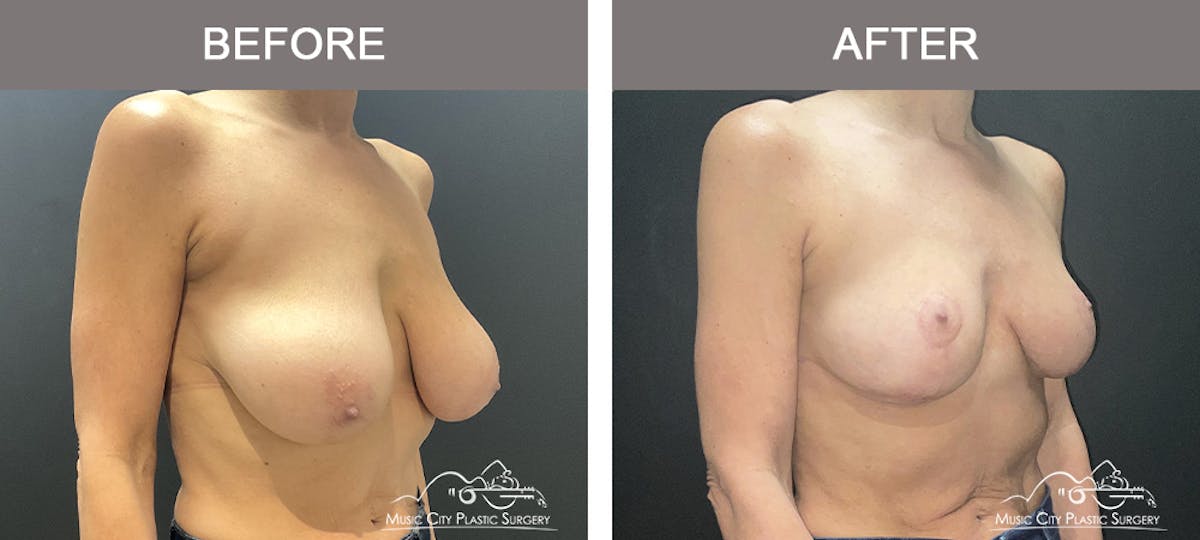 Breast Lift Before & After Gallery - Patient 167552 - Image 2