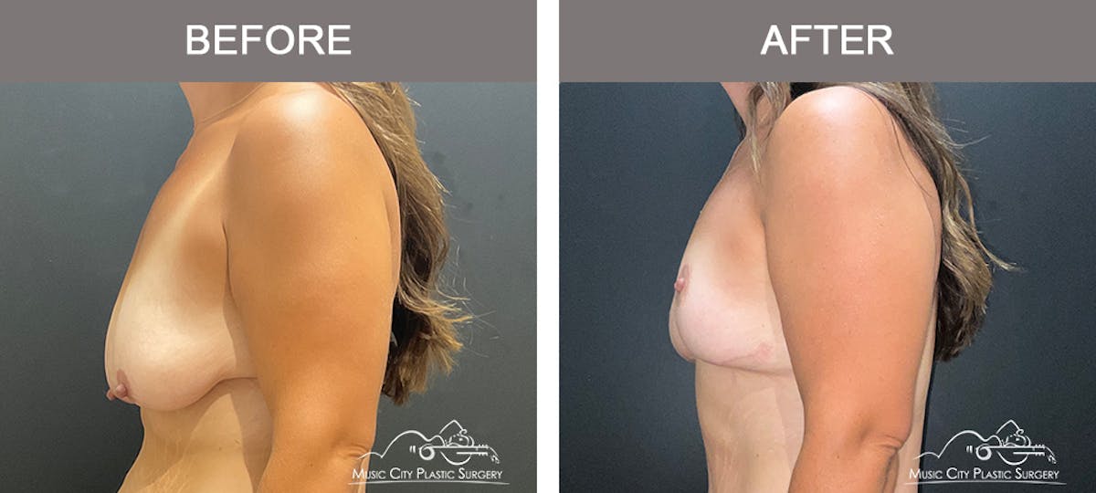Breast Lift Before & After Gallery - Patient 409020 - Image 3