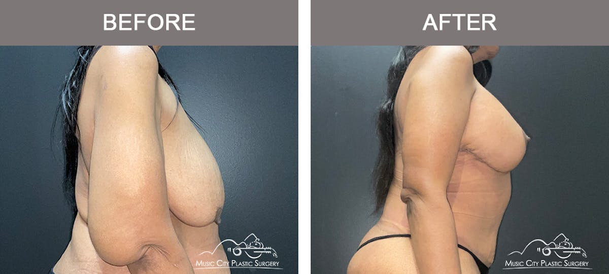 Breast Lift Before & After Gallery - Patient 342180 - Image 3