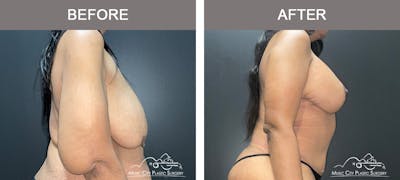 Breast Lift Before & After Gallery - Patient 342180 - Image 3