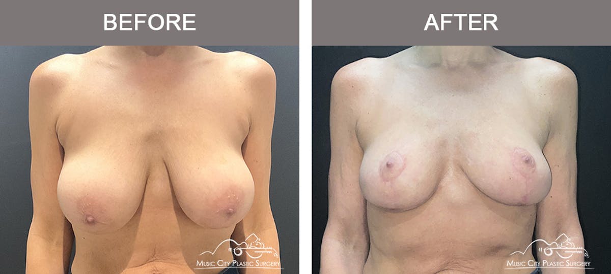 Breast Lift Before & After Gallery - Patient 167552 - Image 1