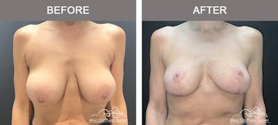Breast Lift Before & After Gallery - Patient 167552 - Image 1