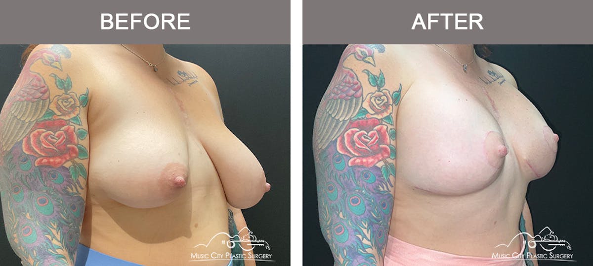 Breast Lift Before & After Gallery - Patient 362510 - Image 2