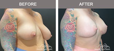 Breast Lift Before & After Gallery - Patient 362510 - Image 2