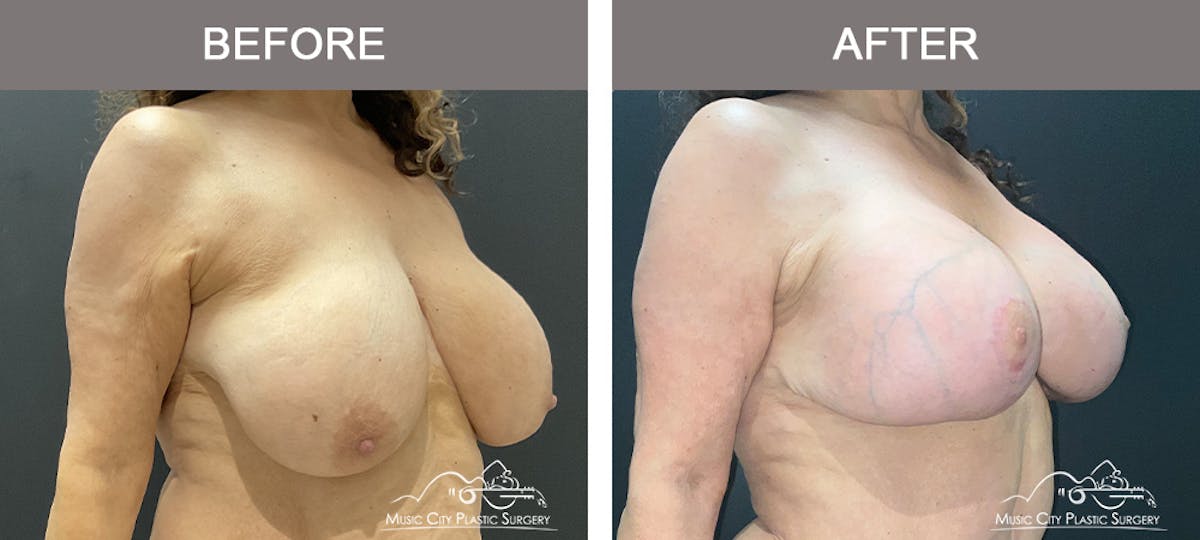 Breast Lift Before & After Gallery - Patient 154251 - Image 2