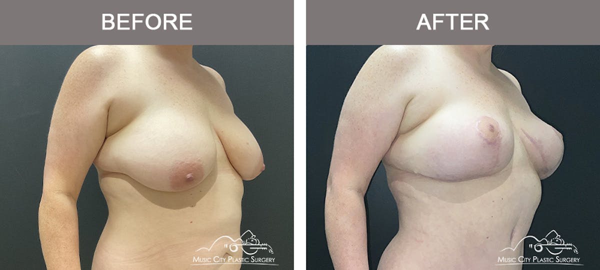 Breast Lift Before & After Gallery - Patient 383368 - Image 2