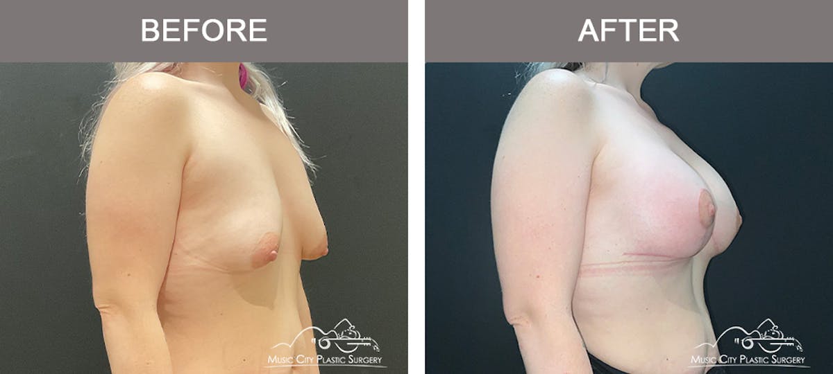Breast Lift Before & After Gallery - Patient 148651 - Image 2