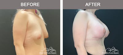 Breast Lift Before & After Gallery - Patient 148651 - Image 2