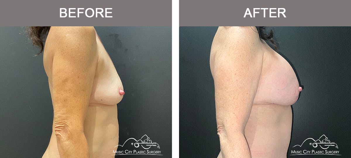 Breast Lift Before & After Gallery - Patient 190716 - Image 3