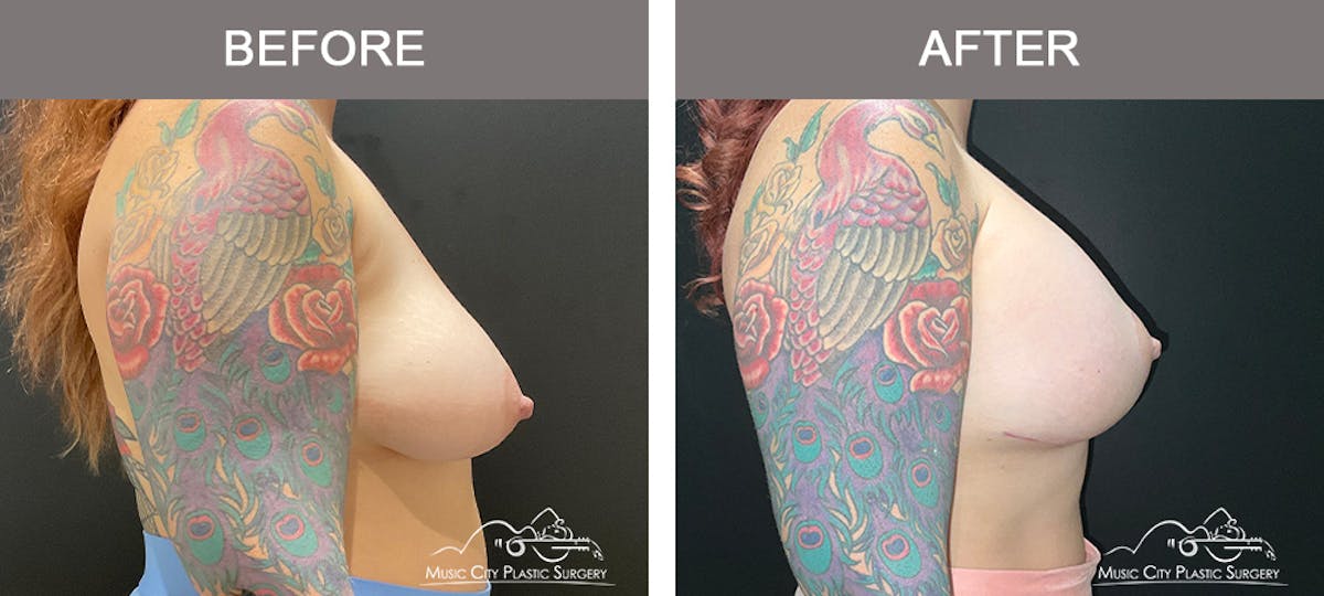 Breast Lift Before & After Gallery - Patient 362510 - Image 3
